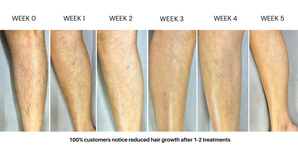ipl laser hair removal handset - before and after