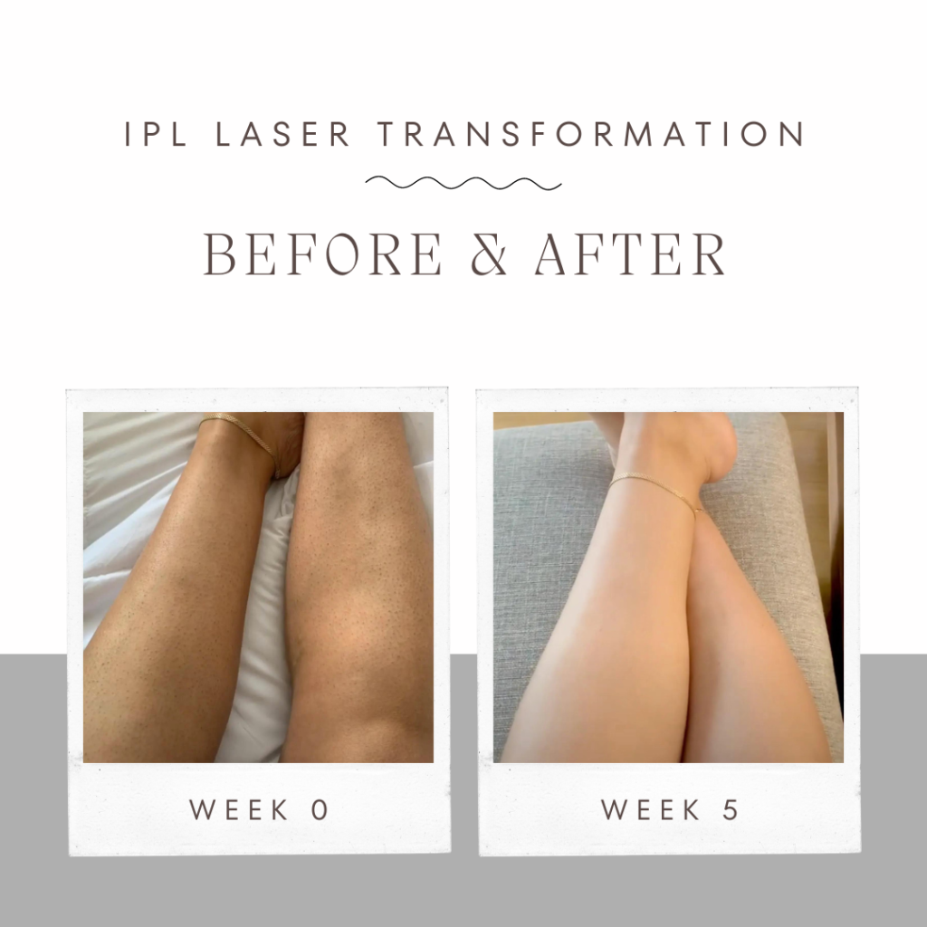 ipl laser hair removal handset - before after legs