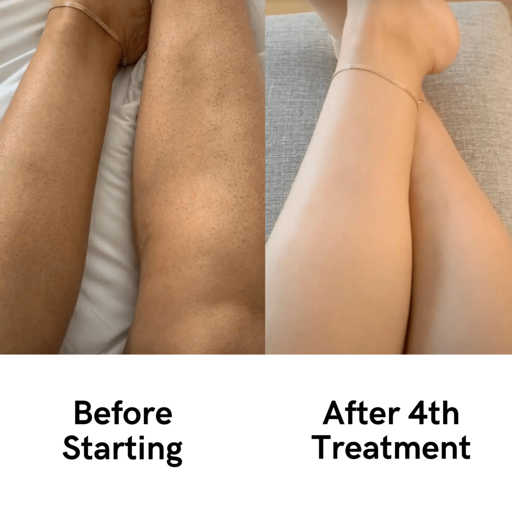 ThePlushCo IPL Hair removal handset Results (Before and After)